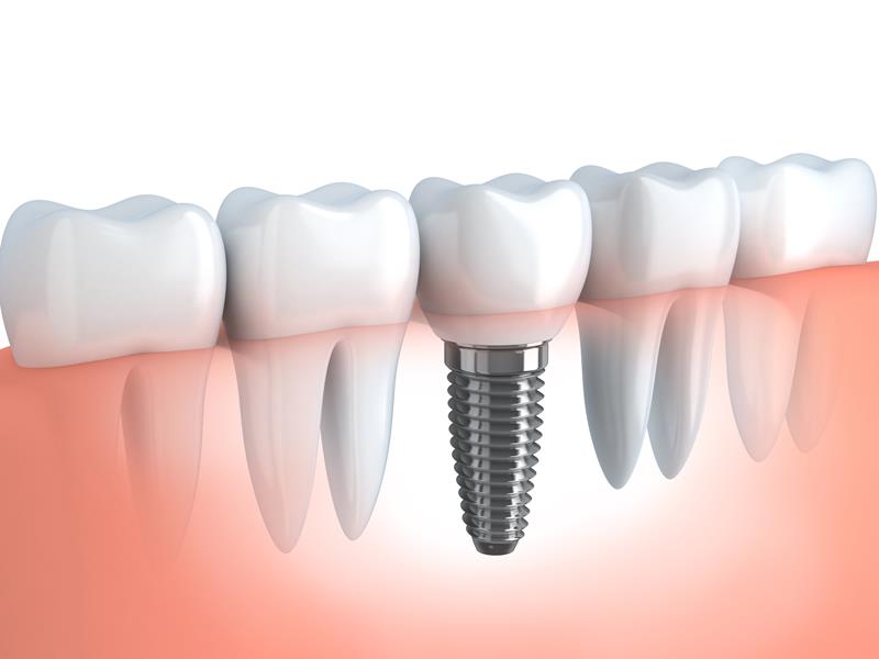 Dental Implants Tonkawa, OK 